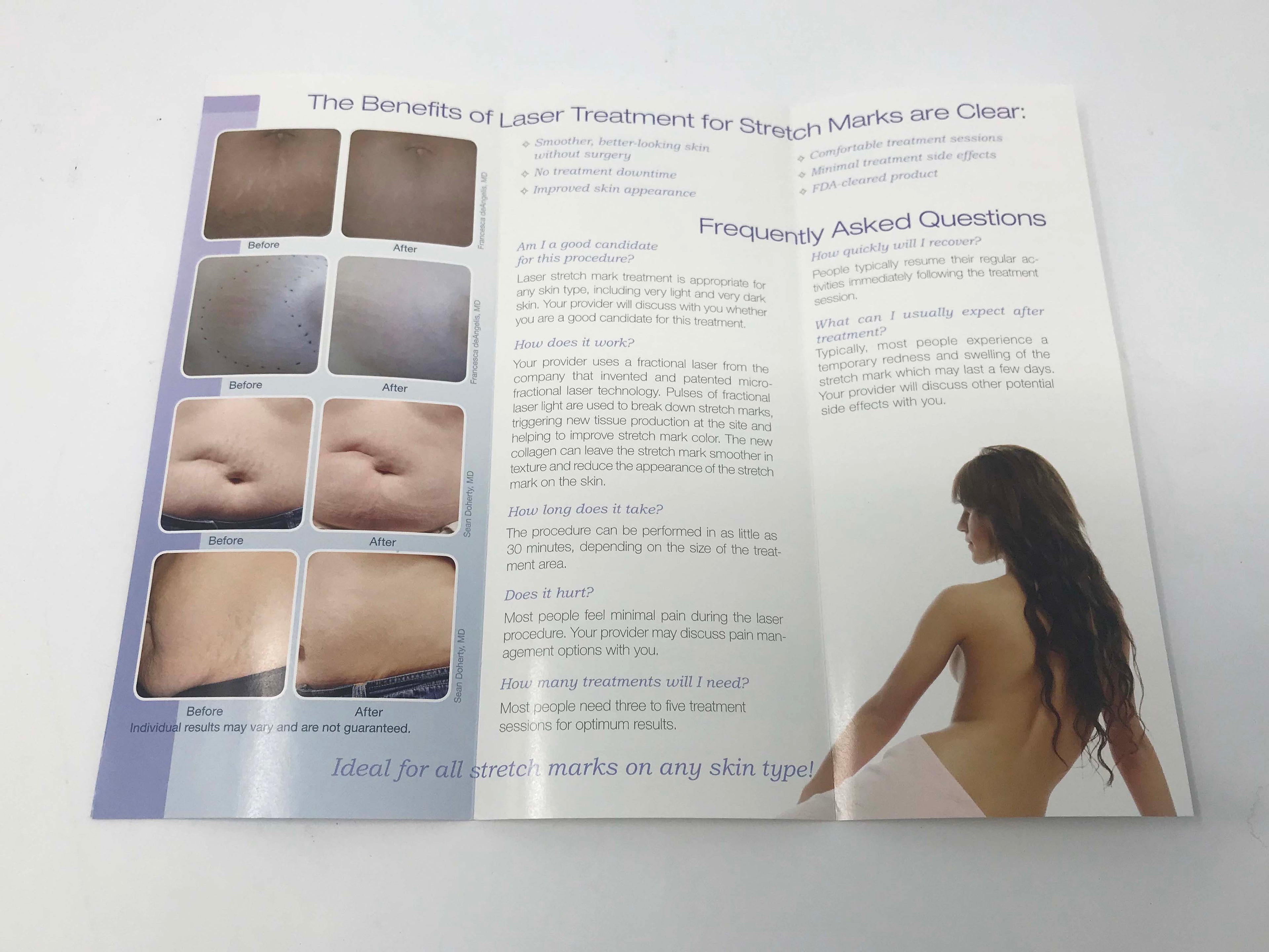 Palomar Fractional Laser Skin Resurfacing Stretch Mark Removal Patient Brochures