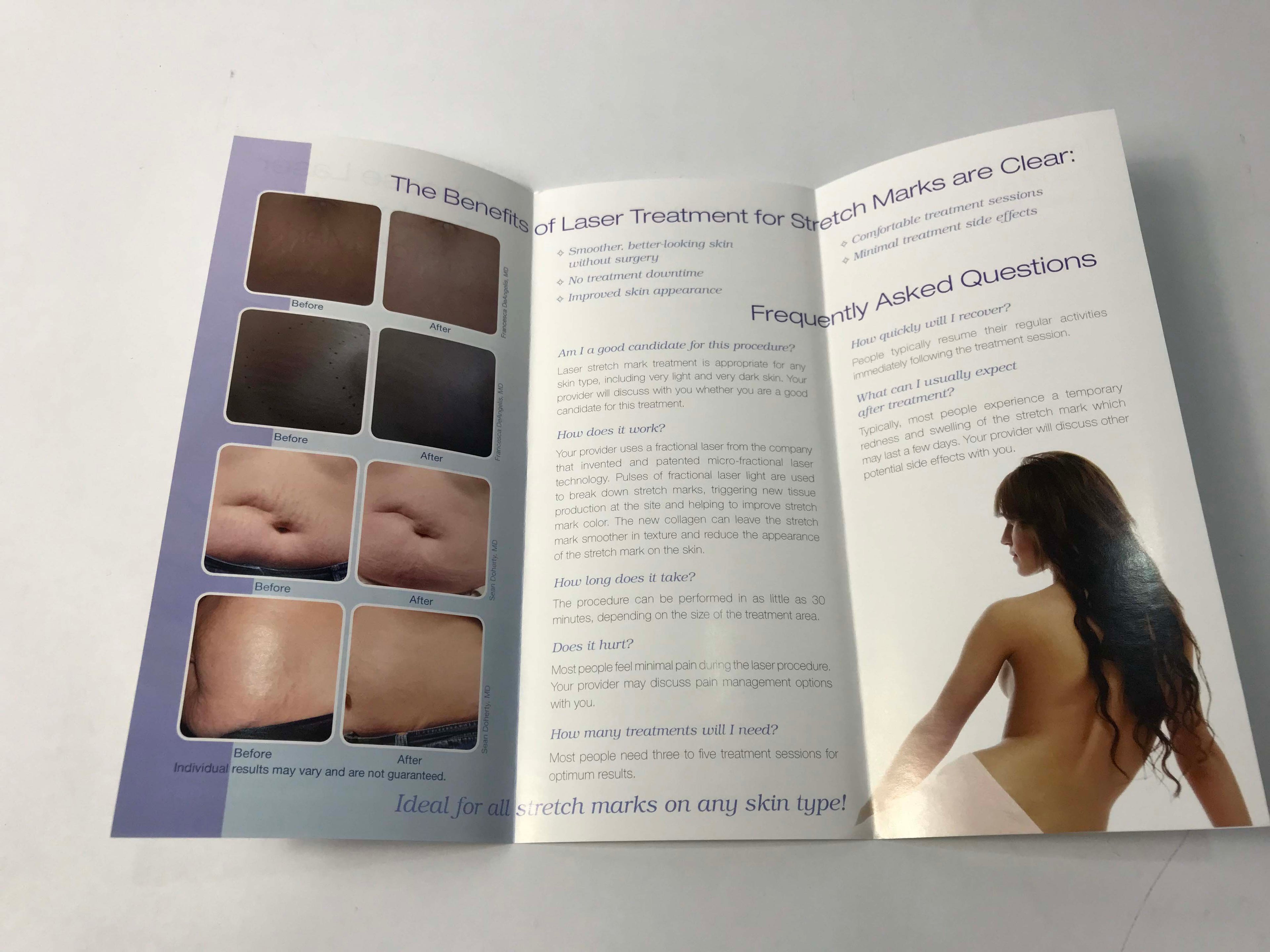 Palomar Lux 1540 Stretch Marks Reduction Laser Treatment Patient Brochures