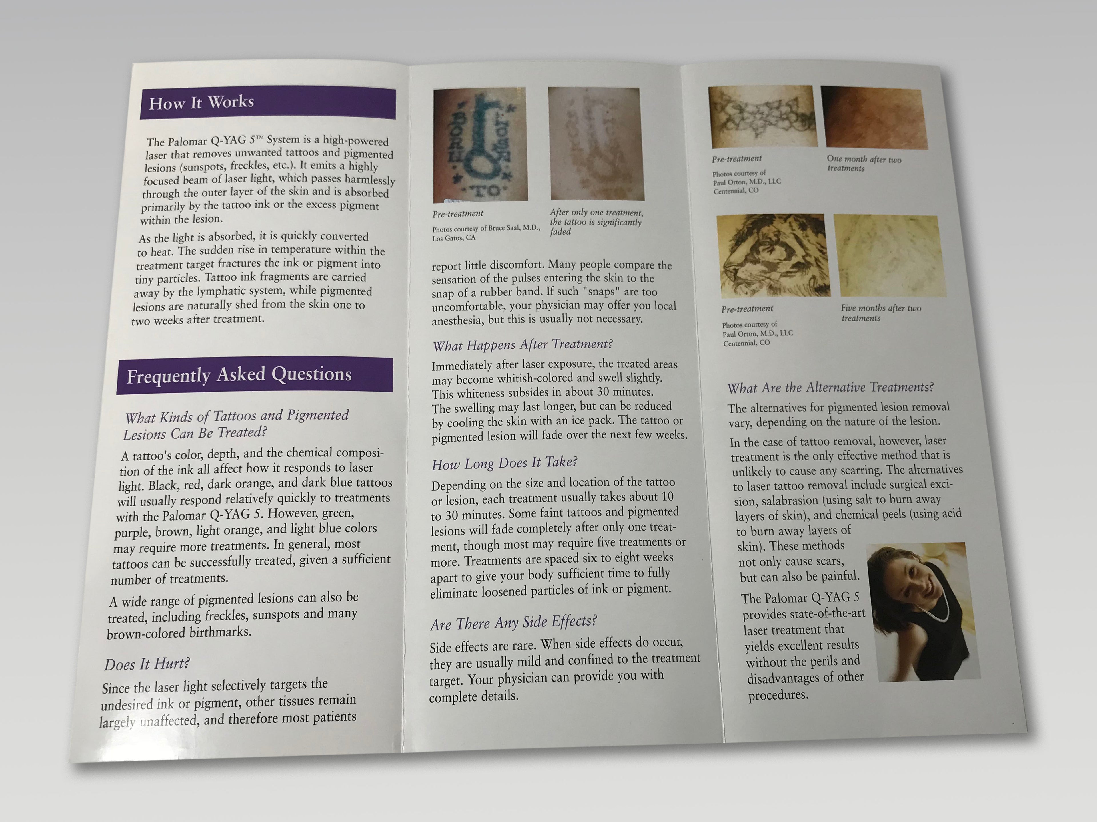 Palomar QYAG5 Laser Q Yag 5 Tattoo Pigmented Lesion Removal Brochures 25-pack