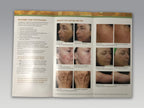 Solta Fraxel Dual 1550 1927 Skin Resurfacing Wrinkle Reduction Patient Brochure