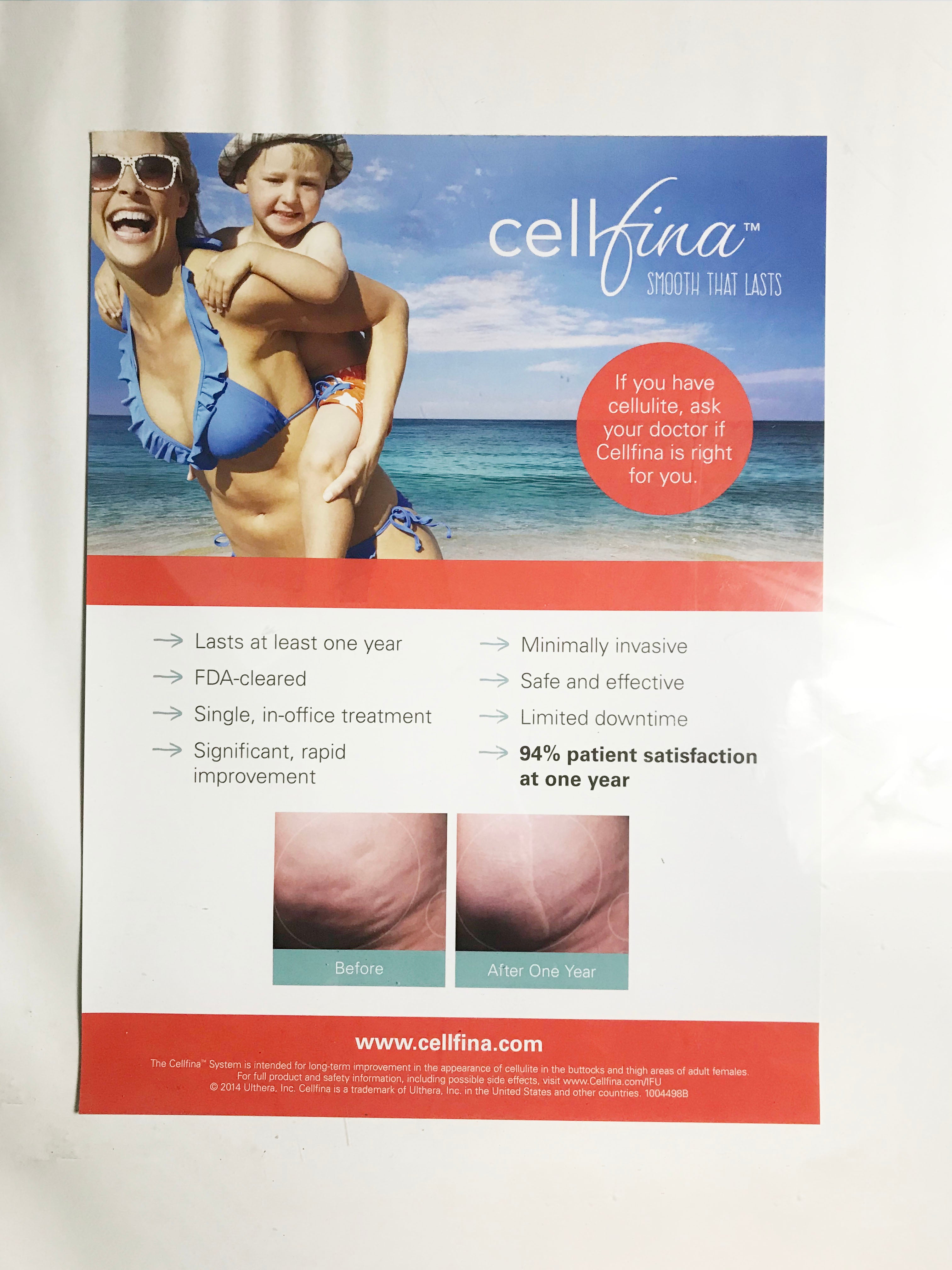 Ulthera Cellfina Skin Tightening Cellulite Reduction 18x24 Inch Marketing Poster