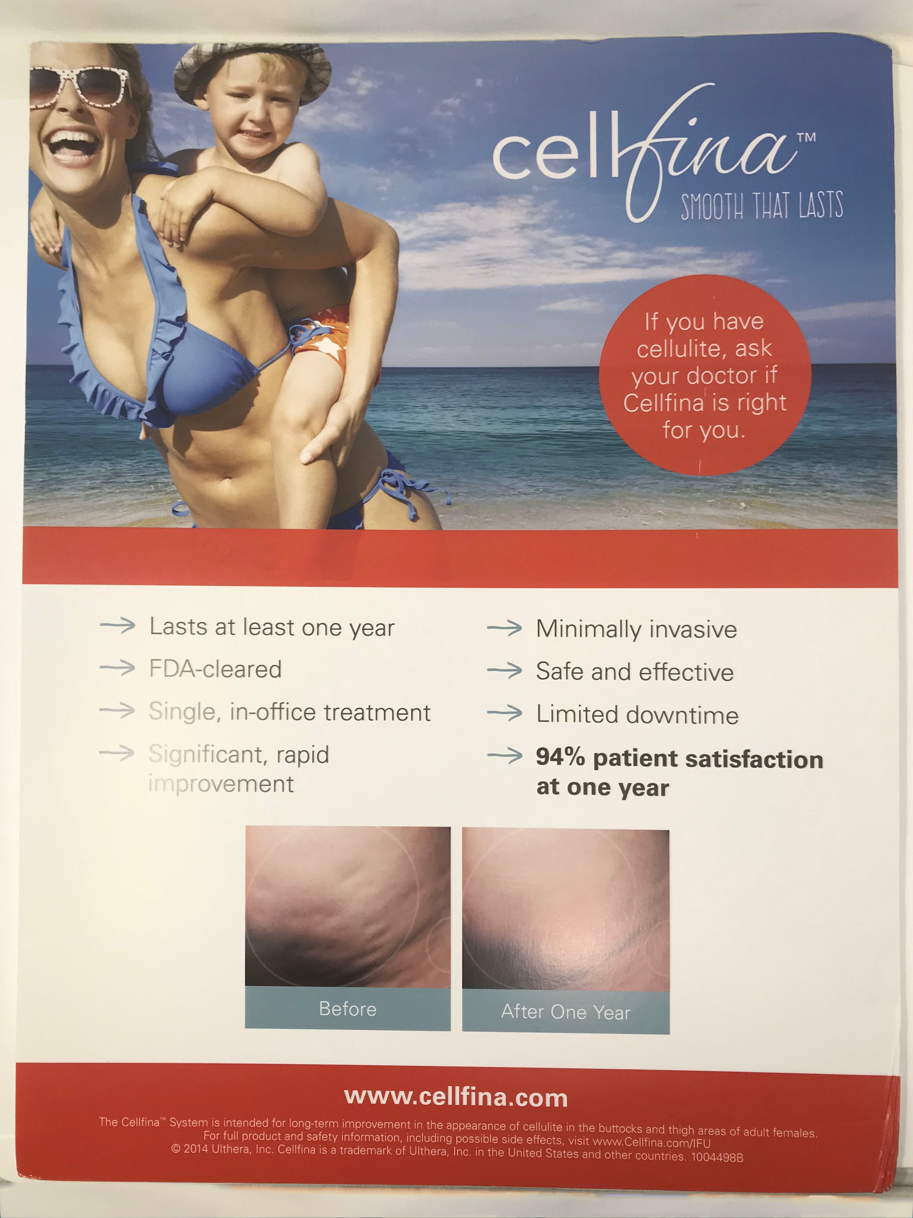 Ulthera Cellfina Skin Tightening Cellulite Reduction Poster Board 18x24 Inches