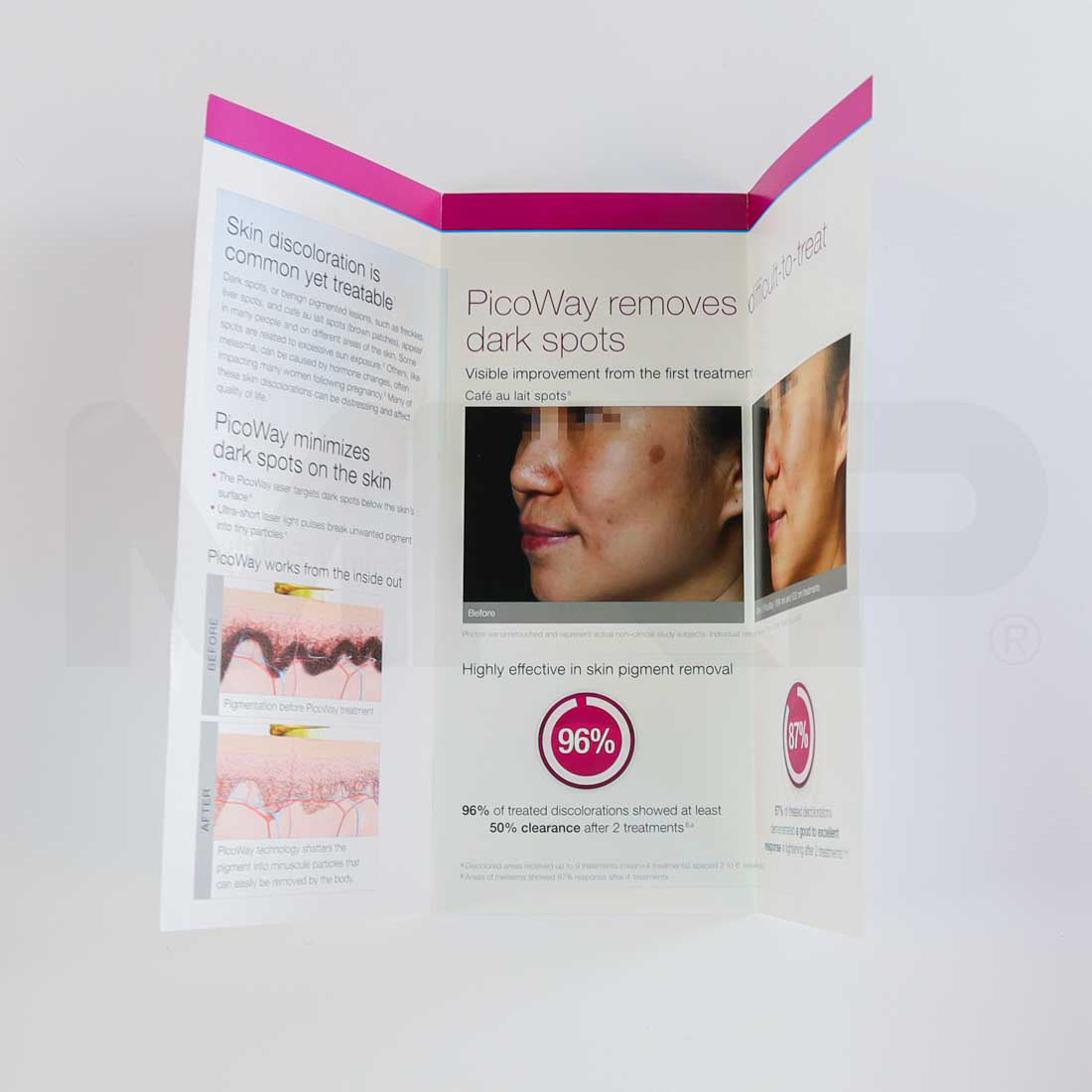 Syneron Candela PicoWay "Remove Boldly Treat Lightly" Brochure Open