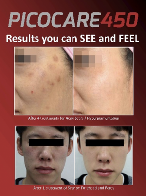 Zarin Picocare 450 Static Cling Poster Decal Skin Rejuvenation Laser Marketing