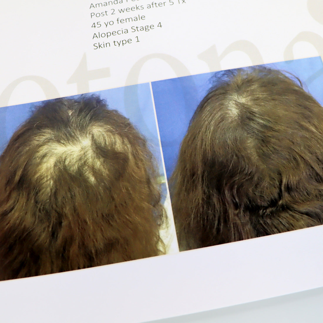 Fotona HAIRestart Epidermal Superficial Thermally Regeneration Marketing Booklet