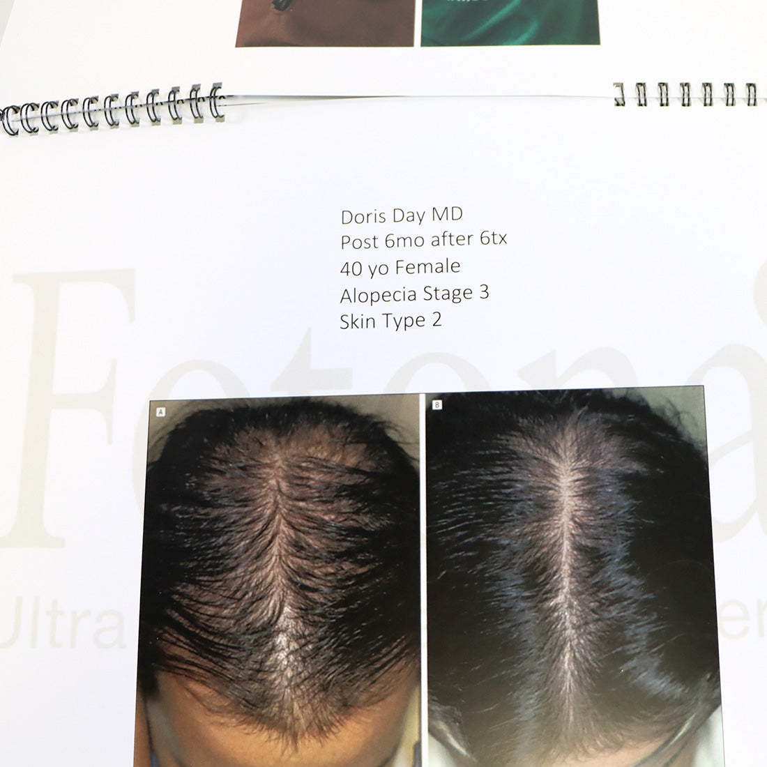 Fotona HAIRestart Epidermal Superficial Thermally Regeneration Marketing Booklet