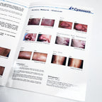 Cynosure SMARTEPIL II Long Pulse Nd YAG Laser Marketing Booklet 920-0175-000