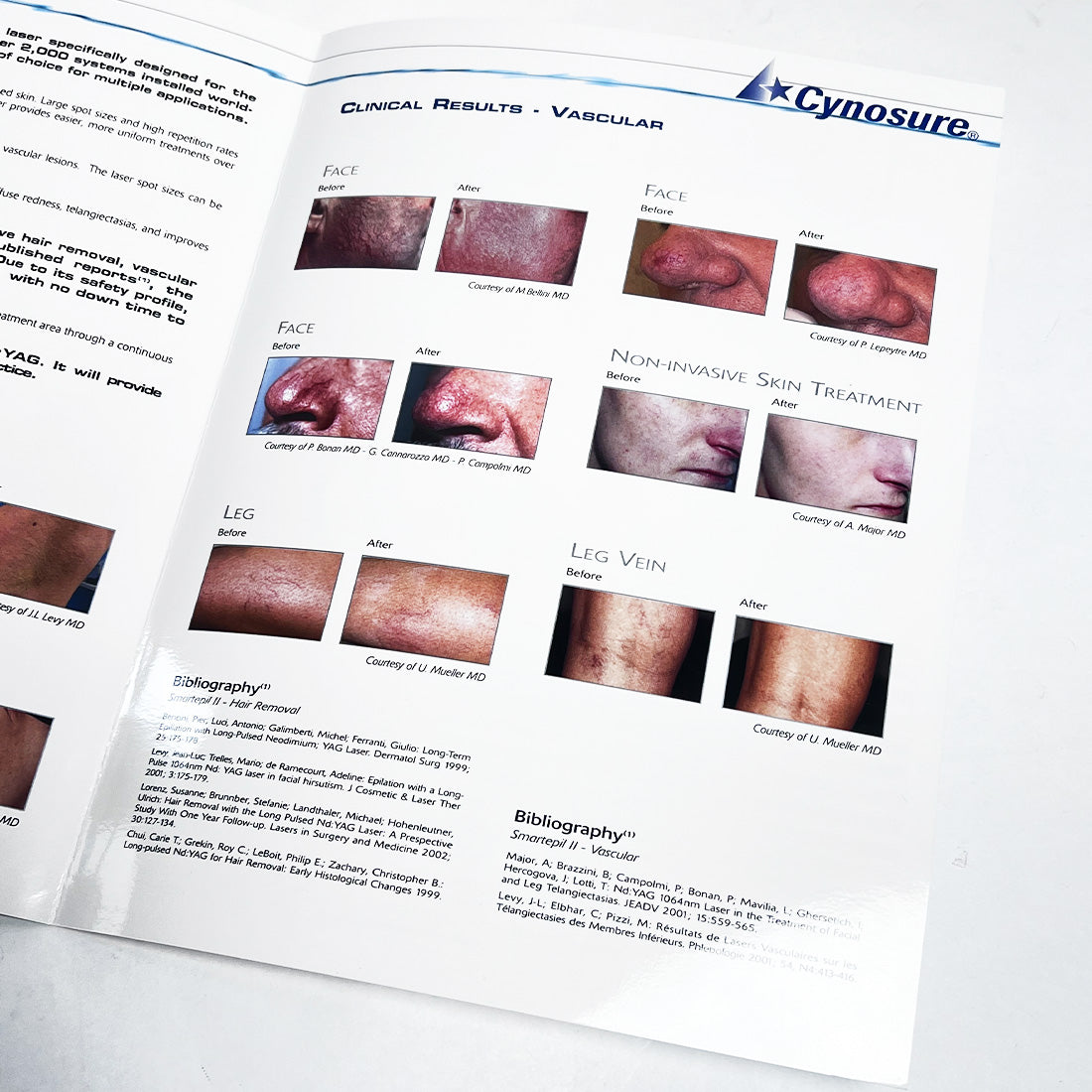 Cynosure SMARTEPIL II Long Pulse Nd YAG Laser Marketing Booklet 920-0175-000