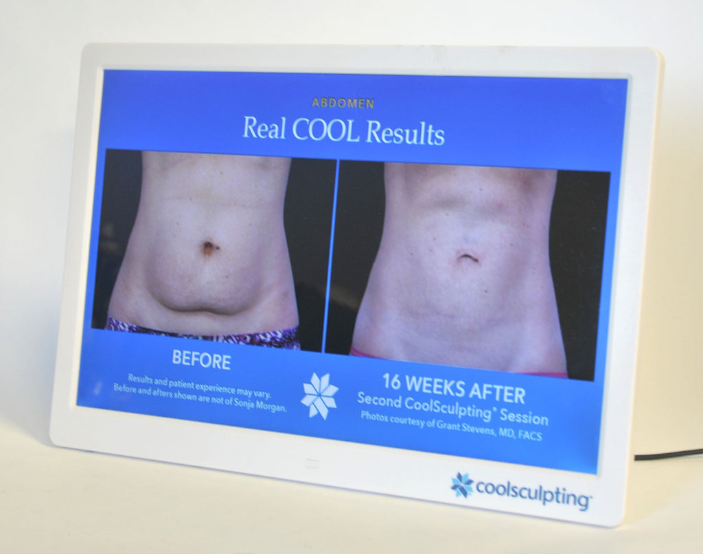 ZELTIQ CoolSculpting Before After Digital Office Photo Frame Display Monitor