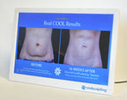 ZELTIQ CoolSculpting Before After Digital Office Photo Frame Display Monitor