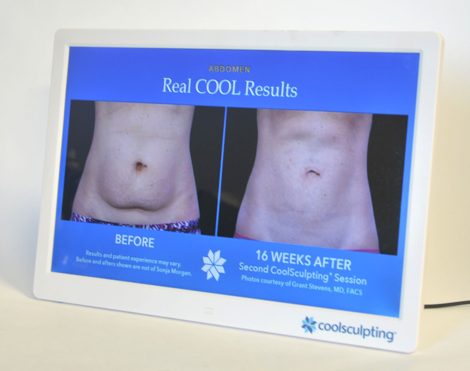ZELTIQ CoolSculpting Before After Digital Office Photo Frame Display Monitor