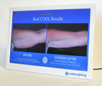 ZELTIQ CoolSculpting Before After Digital Office Photo Frame Display Monitor