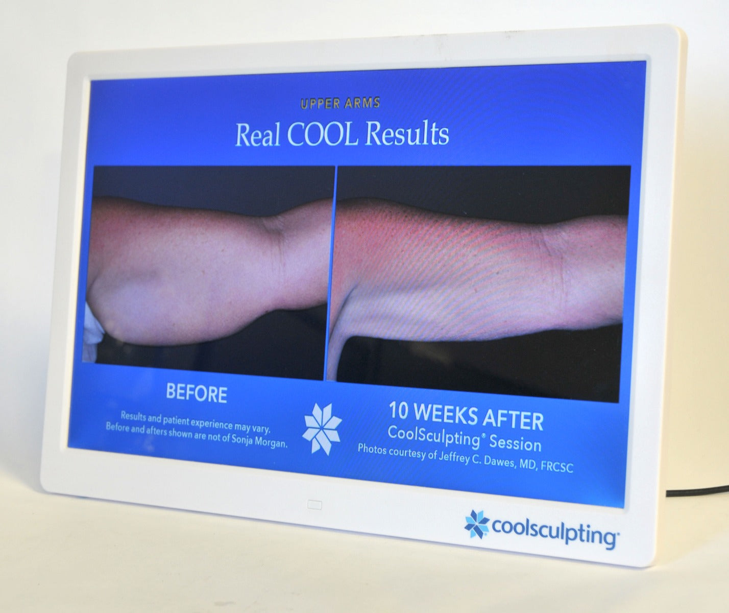 ZELTIQ CoolSculpting Before After Digital Office Photo Frame Display Monitor