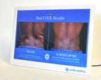 ZELTIQ CoolSculpting Before After Digital Office Photo Frame Display Monitor