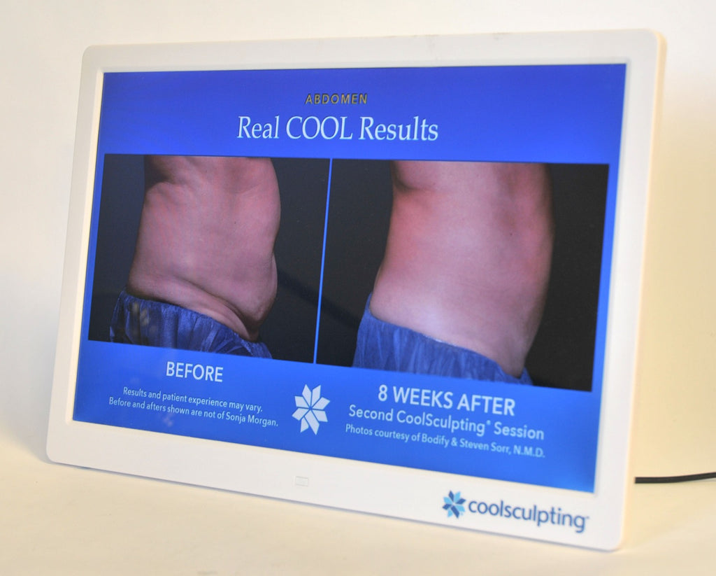 ZELTIQ CoolSculpting Before After Digital Office Photo Frame Display Monitor