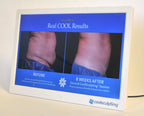 ZELTIQ CoolSculpting Before After Digital Office Photo Frame Display Monitor