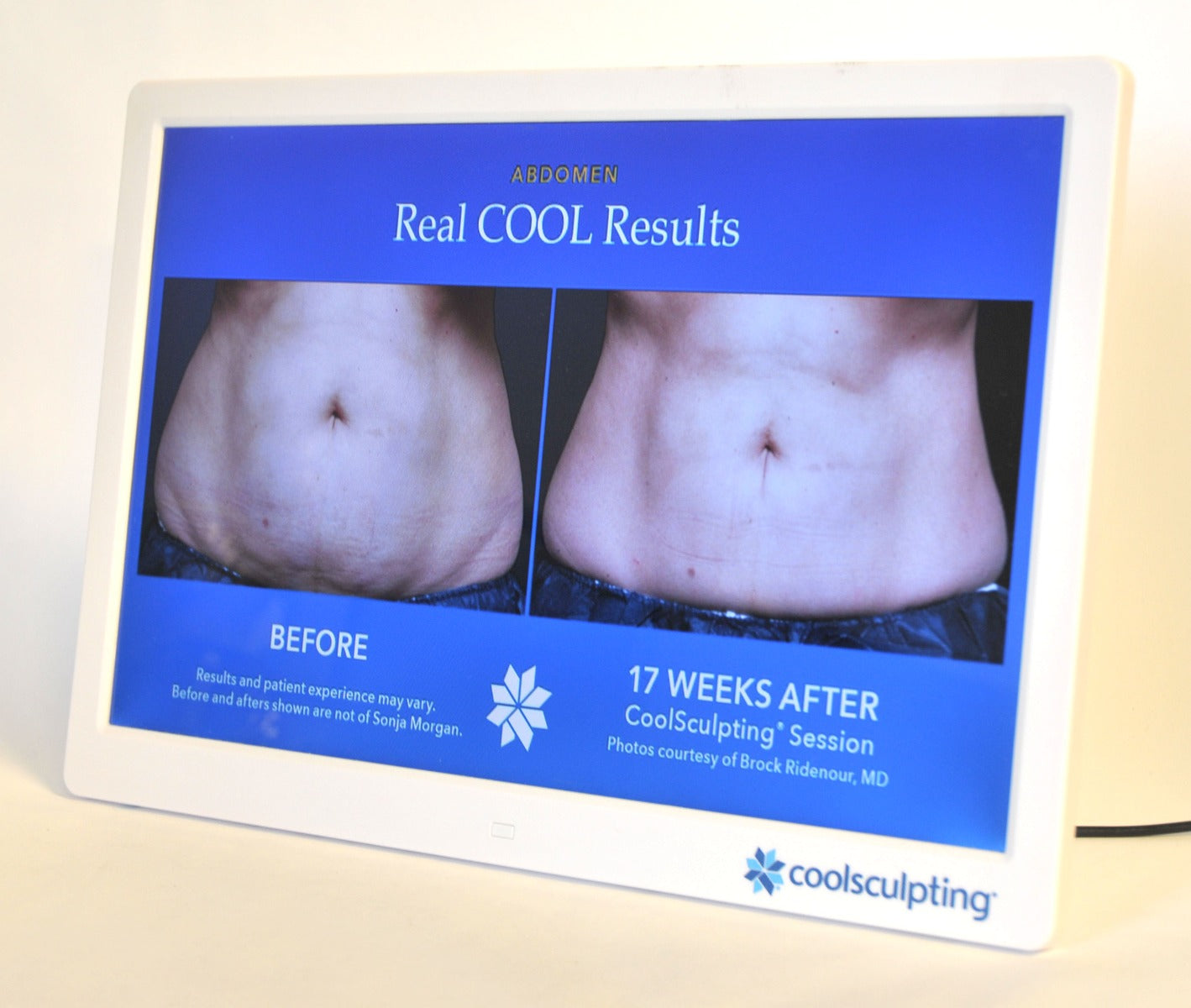 ZELTIQ CoolSculpting Before After Digital Office Photo Frame Display Monitor