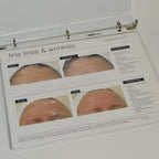 Edge Systems Hydrafacial Before & After Picture Book Patient Marketing 19213-B
