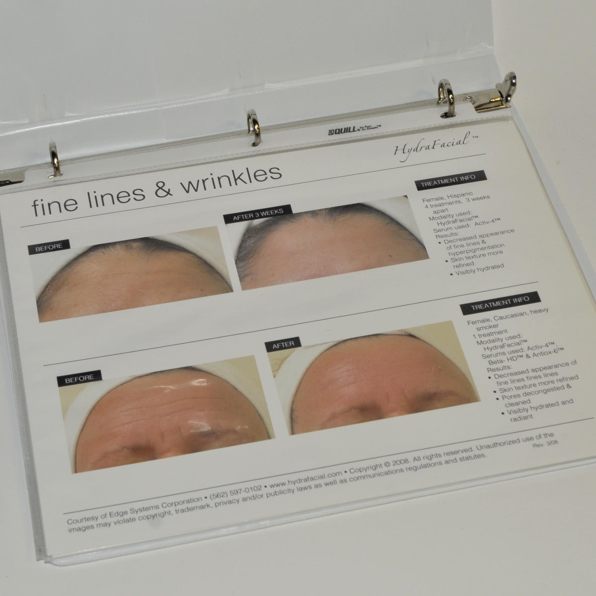 Edge Systems Hydrafacial Before & After Picture Book Patient Marketing 19213-B