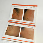 Aesthera Isolaz LASER Office Marketing Consulting Before After Brochure Book