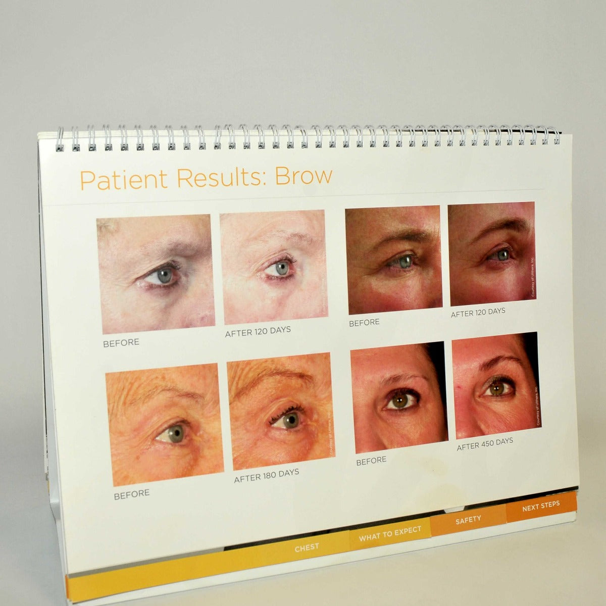 Ultherapy Consultation Patient Marketing Face Wrinkles Office Treatment Photos