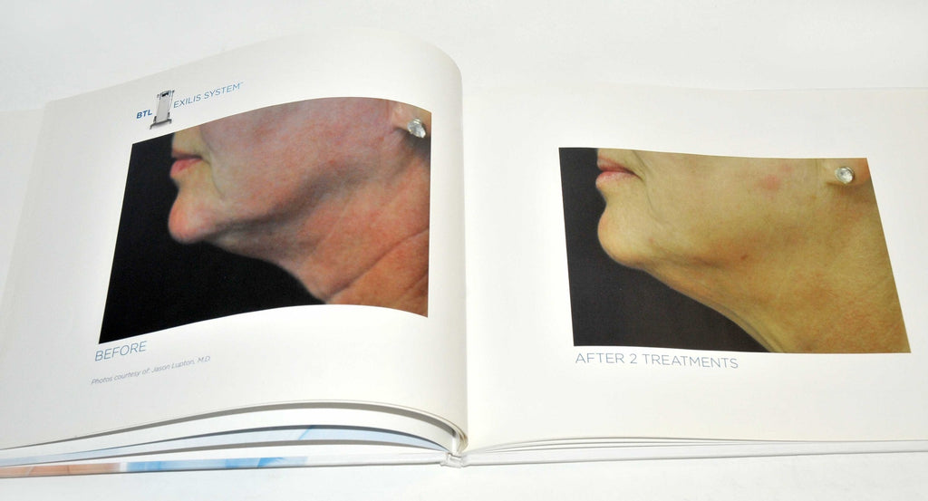 BTL Aesthetics Exilis System Patient Before After Treatment Photos Office Book