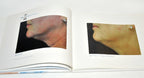 BTL Aesthetics Exilis System Patient Before After Treatment Photos Office Book