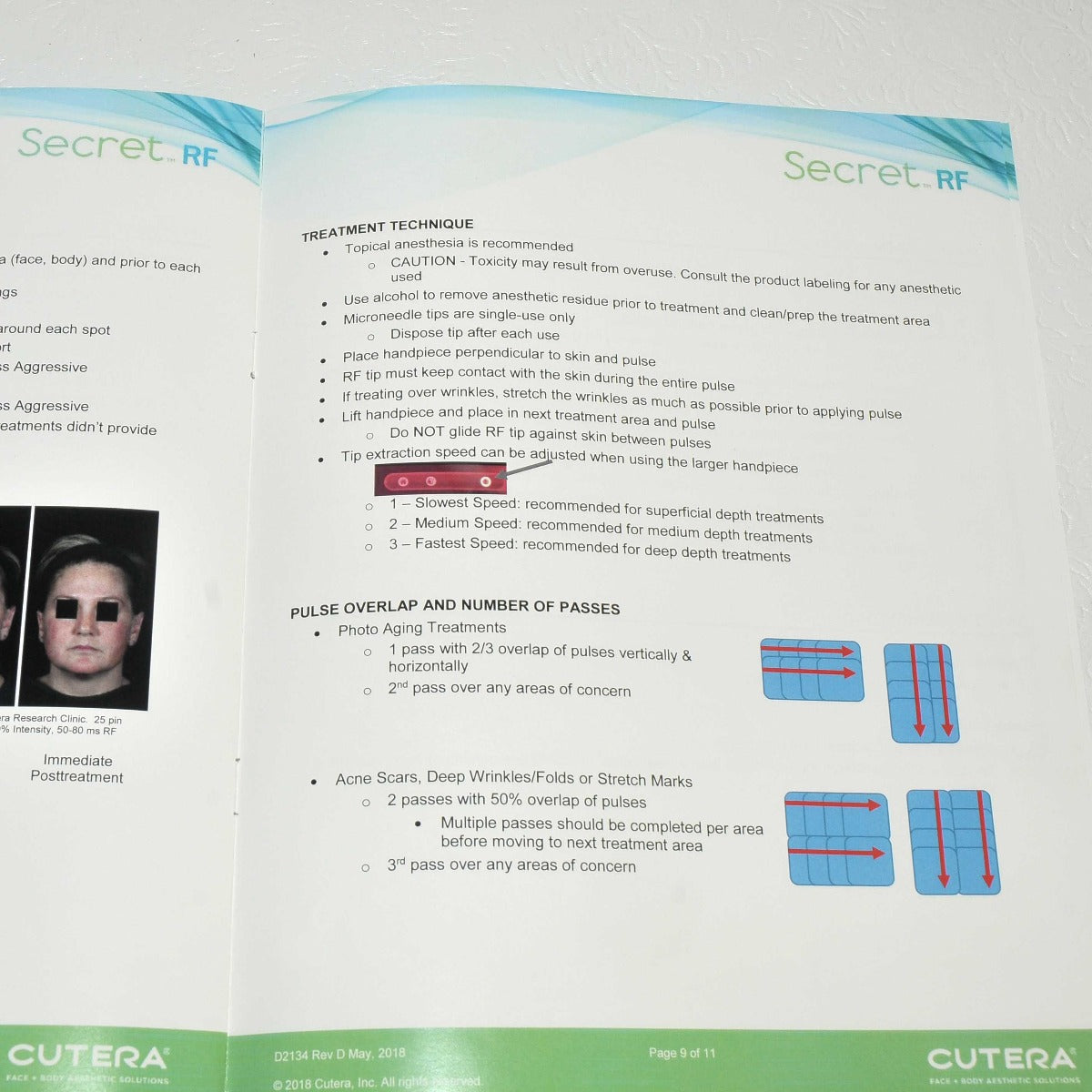 Cutera Secret RF TREATMENT GUIDELINES Operator User Guide Reference Tips D2134