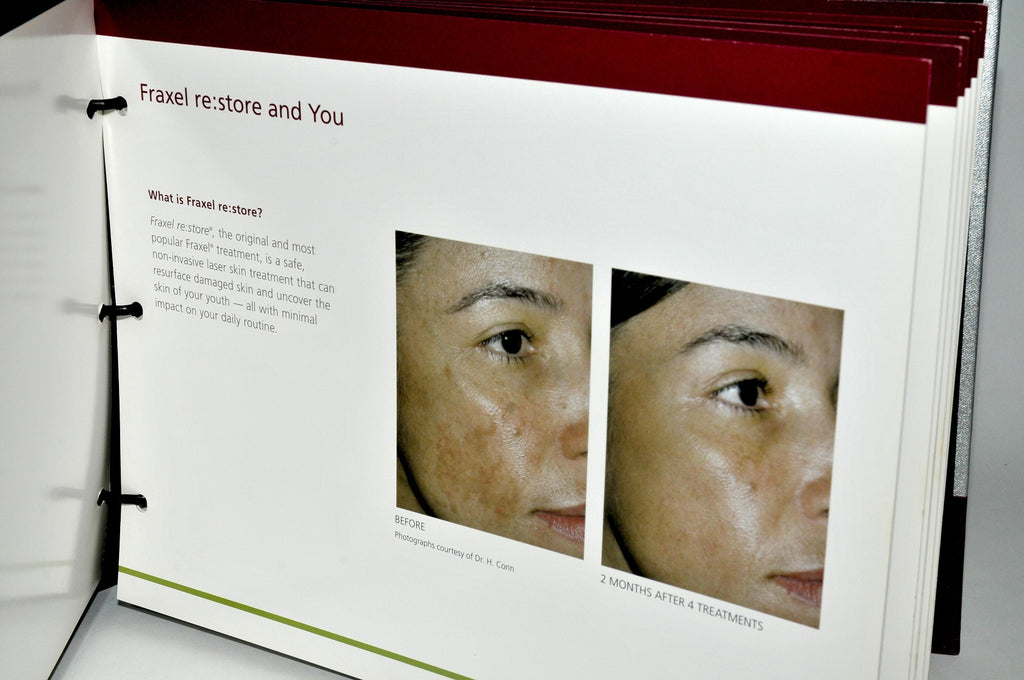 Fraxel Re:Store Patient Clinic Marketing Book Treatment Before After Photos