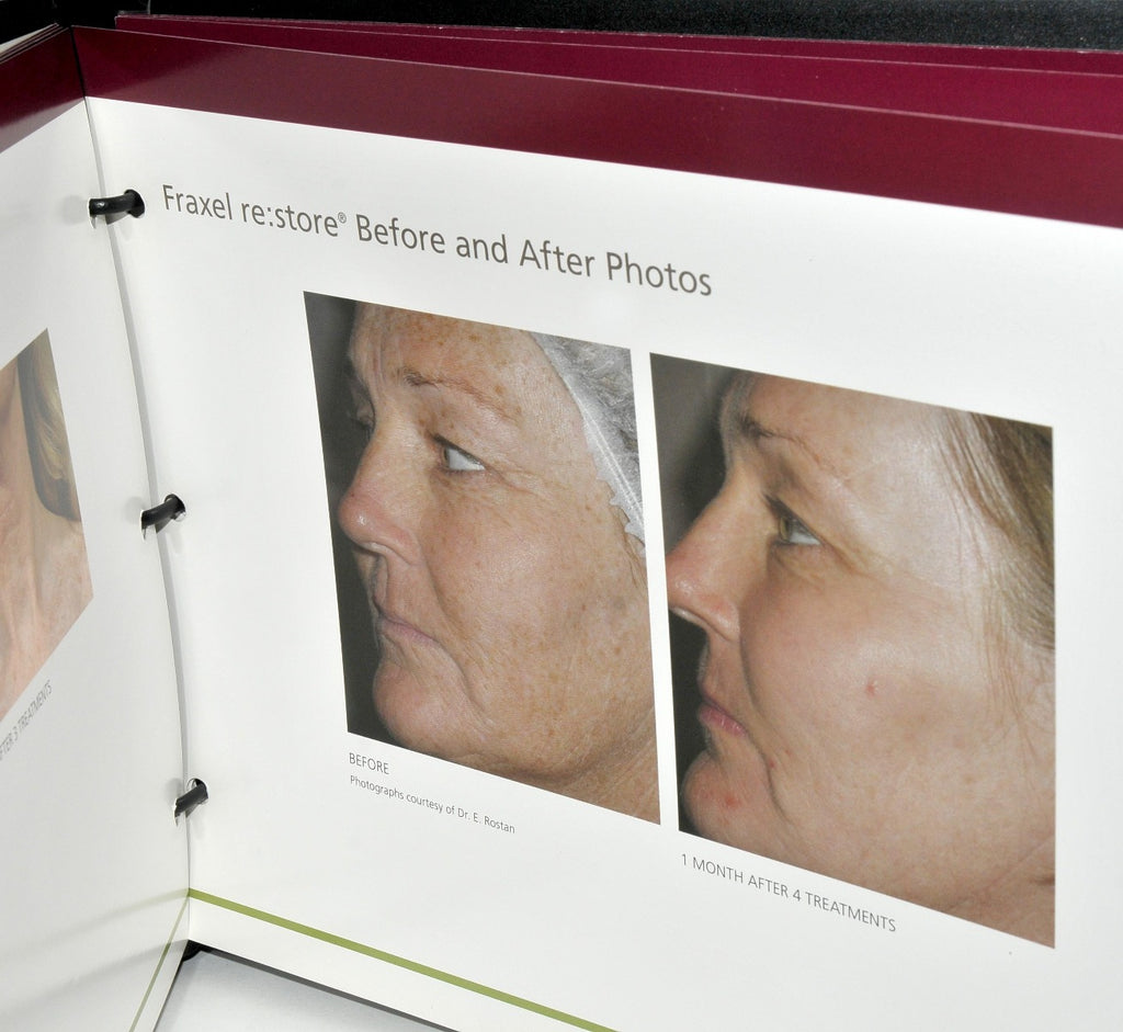 Fraxel Re:Store Patient Clinic Marketing Book Treatment Before After Photos