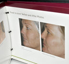 Fraxel Re:Store Patient Clinic Marketing Book Treatment Before After Photos