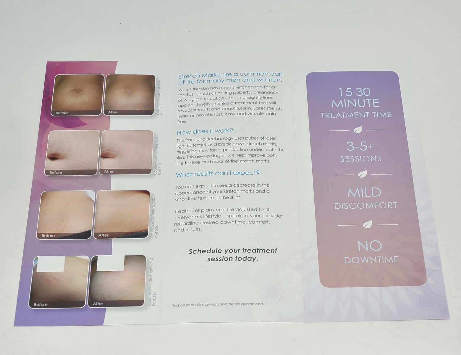 Cynosure ICON Laser Smooth Skin Stretch Mark Removal Patient Brochure x25Pcs