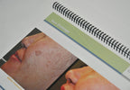 Cutera Laser Before After Photobook Photos Genesis Limelight Titan Hair Removal