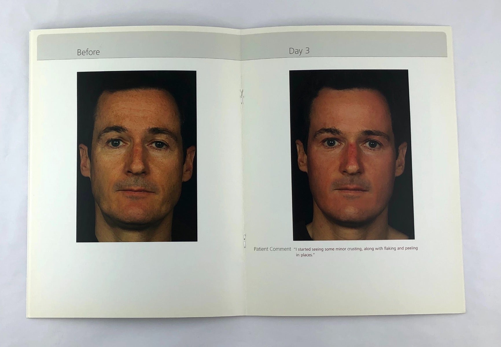 Fraxel re:pair Treatment Patient Diary Before & After Progress Booklet
