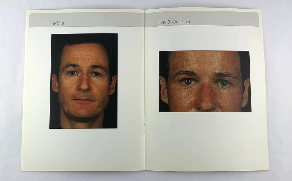 Fraxel re:pair Treatment Patient Diary Before & After Progress Booklet