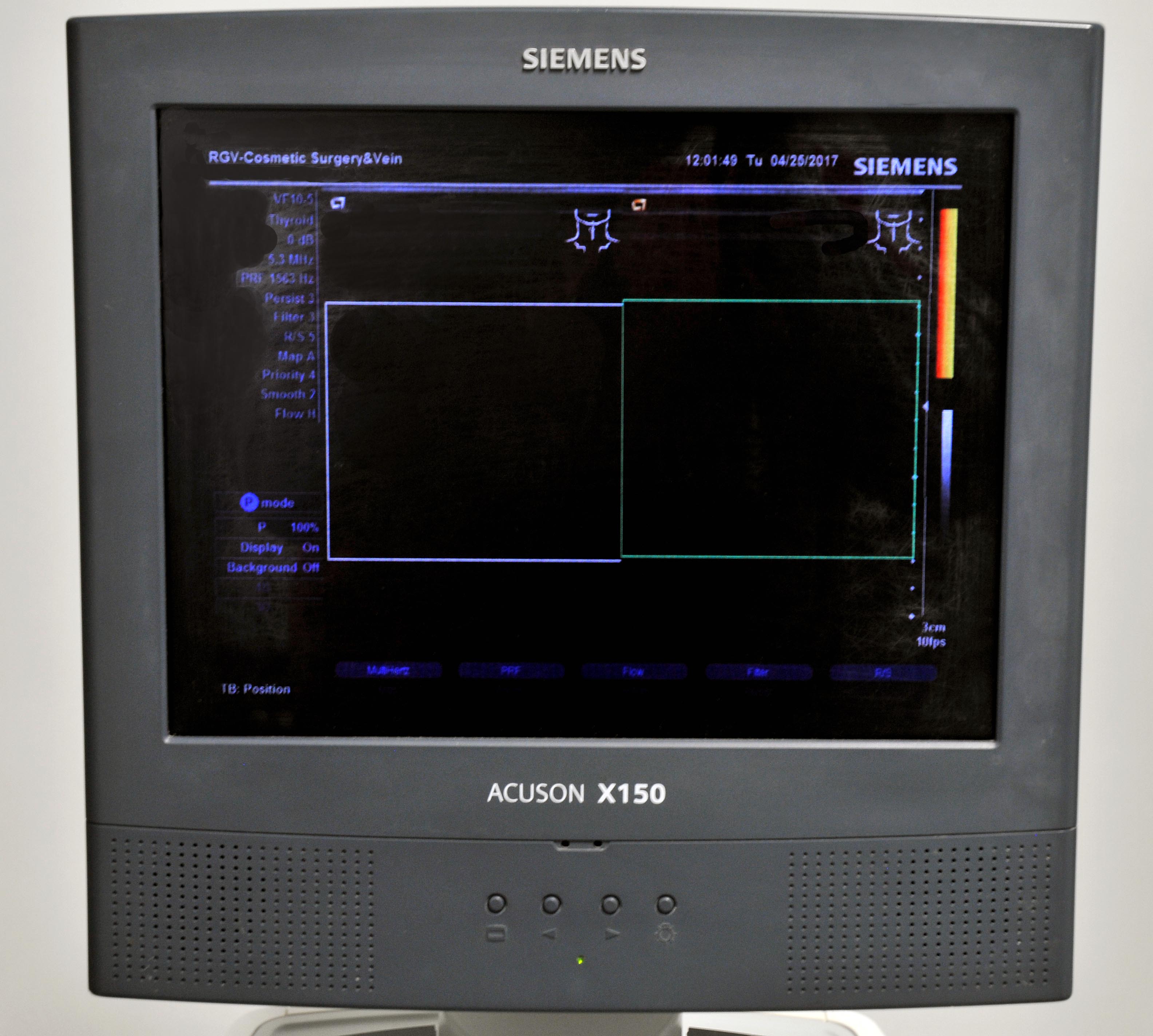 Siemens ACUSON X150 Ultrasound Sonogram Doppler Imaging Pulsed Wave System X 150