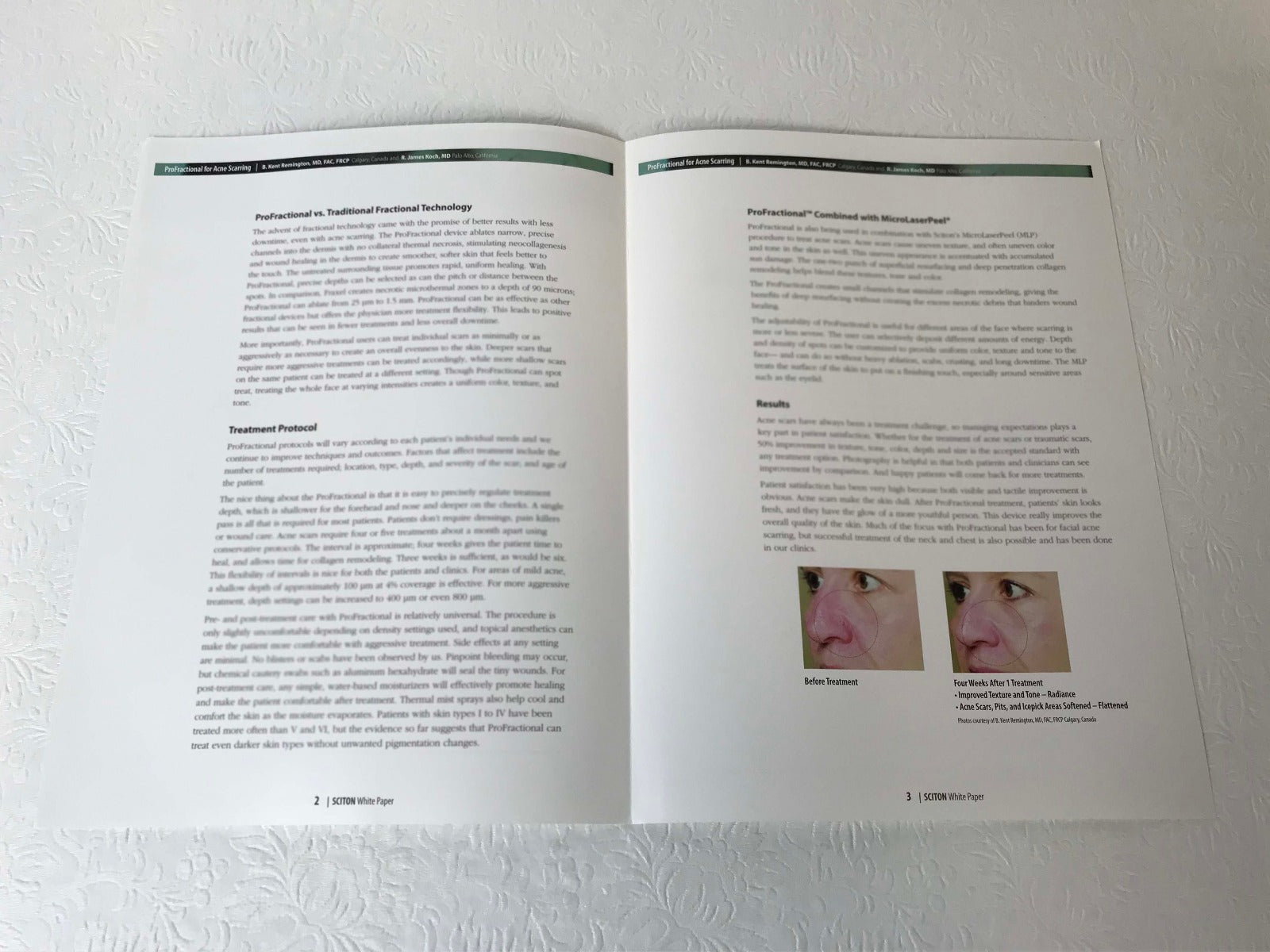Sciton ProFractional Laser Acne Scarring Informative Clinical White Paper QTY 22