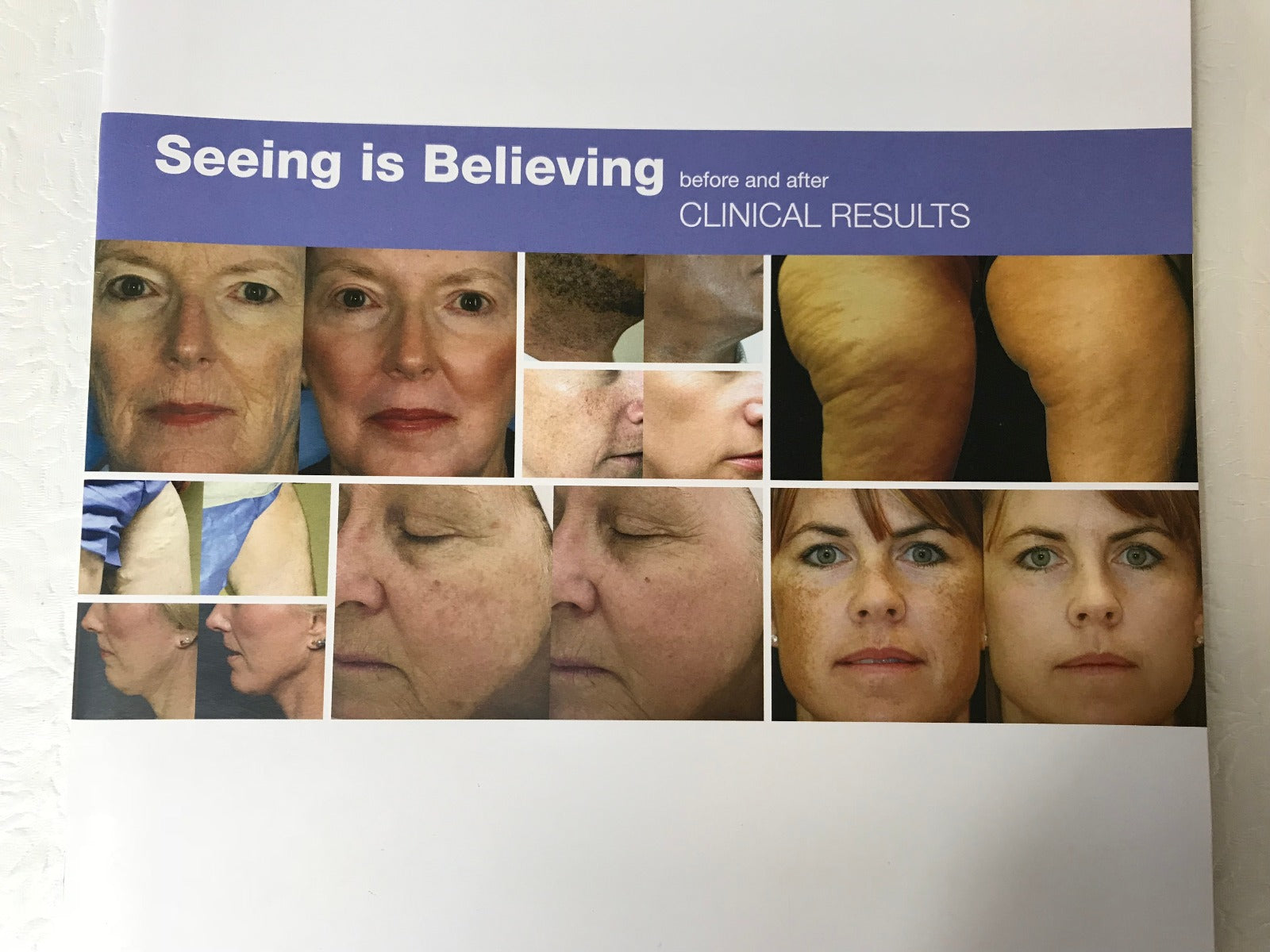 Sciton Joule Laser Seeing Is Believing Results Before & After Photo Book