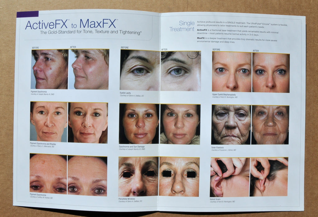 Lumenis UltraPulse Encore ActiveFX MaxFX Before After Result Photos Brochure