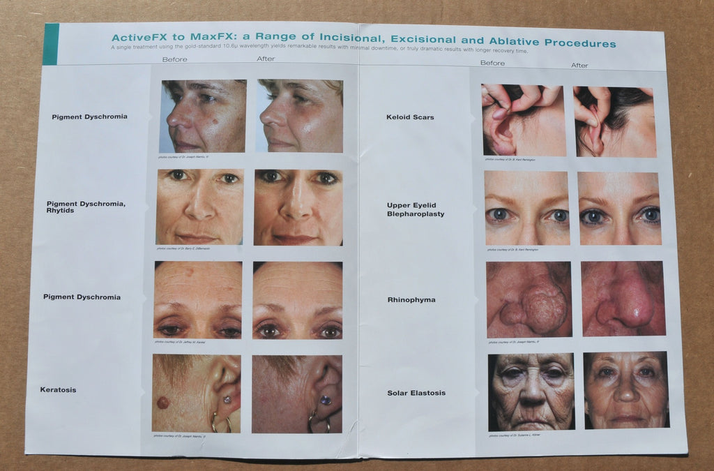 Lumenis UltraPulse Encore ActiveFX MaxFX Laser Skin Treatment Result Brochure