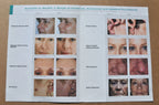 Lumenis UltraPulse Encore ActiveFX MaxFX Laser Skin Treatment Result Brochure