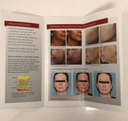 LUTRONIC INFINI Micro MicroNeedle RF Radio Brochure Patient Infinity