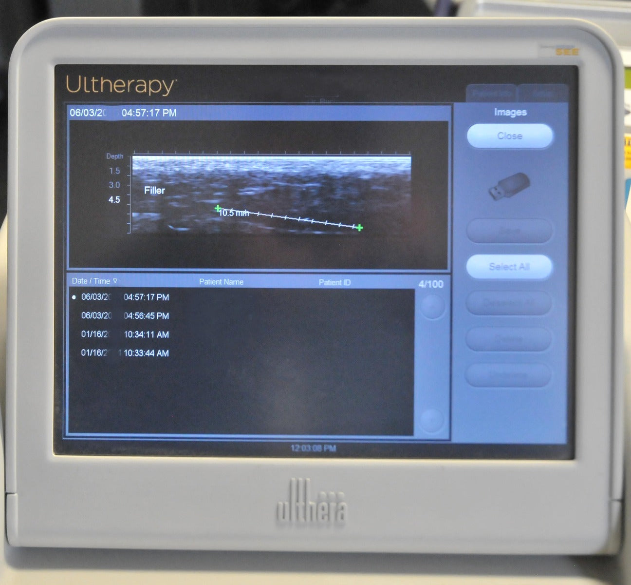 2013 Ulthera Ultherapy UC-1 DEEPsee Ultrasound Skin Tightening Lifting System