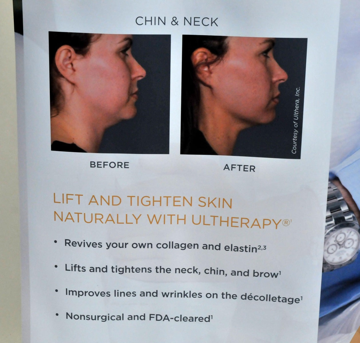 Ultherapy Lift Skin Tightening Chin Neck Christie Brinkley Vinyl Office Banner