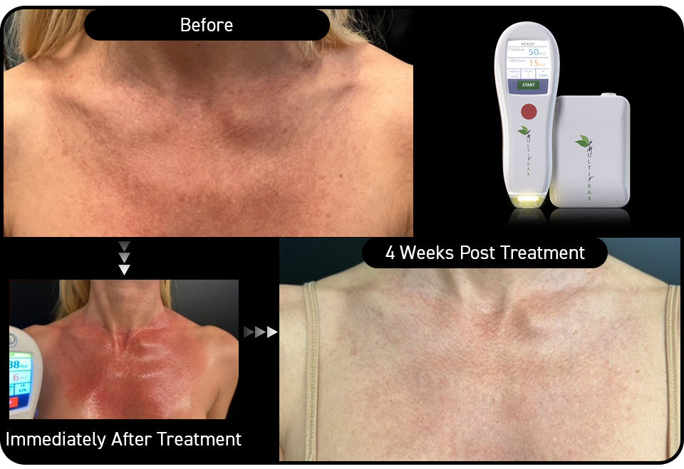 Décolletage hyperpigmentation — one treatment