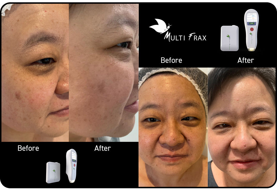 Full face global rejuvenation — one treatment
