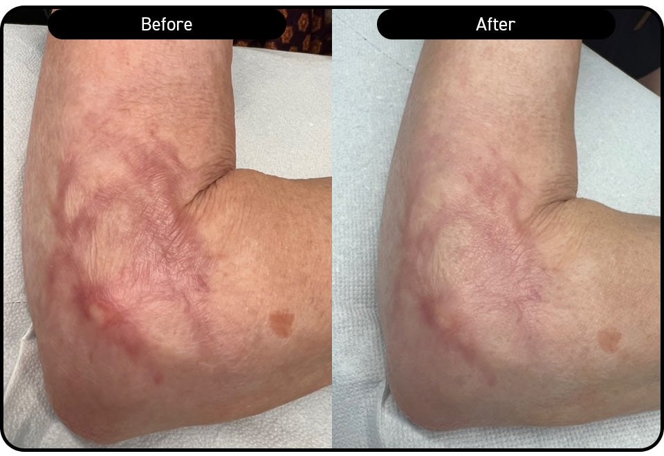 Elbow scarring — two treatments