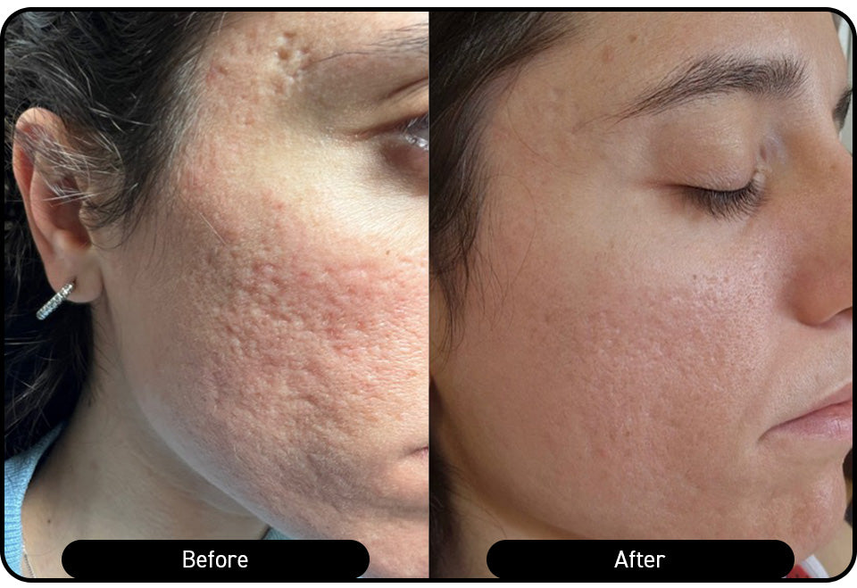 Acne scarring — two treatments