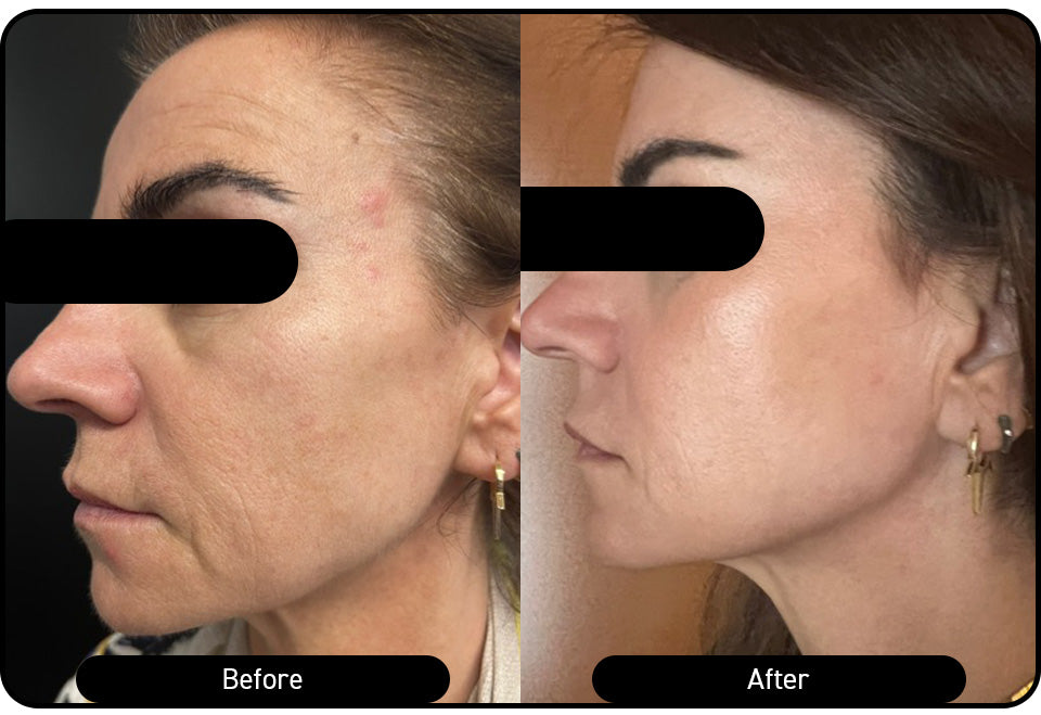 Global rejuvenation — four weeks post